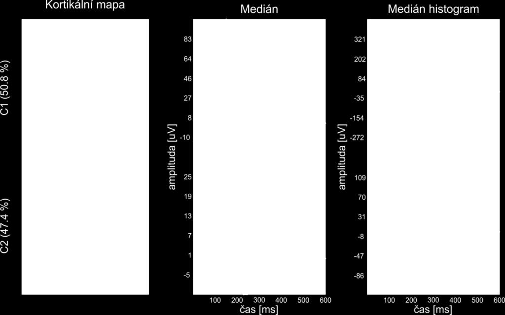 Kapitola 3 Výsledky elektrod 47 48, naopak druhý shluk zobrazuje propagaci v opačném směru. To by vysvětlovalo výskyt dvou typů výbojů v referenčních elektrodách. Výboje v okcipitální (el.