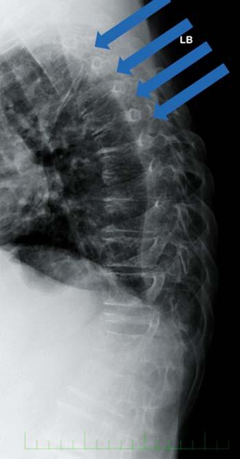 Obr. 2. RTG snímek kompresivních fraktur v oblasti hrudní páteře u nemocného s MM Obr. 3. Osteolytická ložiska detekovaná na LD CT skeletu.