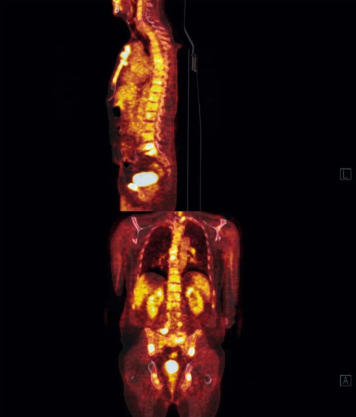 Obr. 6. PET/CT vyšetření u pac. s mnohočetným myelomem s nálezem mnohočetných ložisek v oblasti celé páteře, hrudní kosti, pánevních kostí ložisek myelomu (19), obrázek 6.