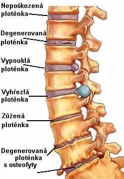 Obr. 5 Typy poškození meziobratlových