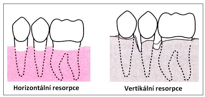každému zubu. 2 Jako povrchová parodontitida (parodontitis marginalis superficialis) se nazývá stav, kdy úbytek kosti dosahuje maximálně jedné třetiny zubního kořene.