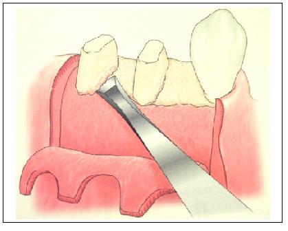 směrem apikálním, laterálním nebo koronárním, čímž se dosáhne nové kontury gingivy. Po operaci se často objevuje edém a bolestivost.