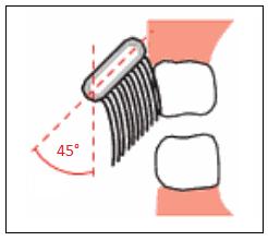 Metoda je velmi účinná při odstraňování supragingiválního i subgingiválního zubního plaku, avšak při velkém tlaku může dojít k poškození gingivy. 8 Obrázek 14 Bassova technika 8 6.1.2.