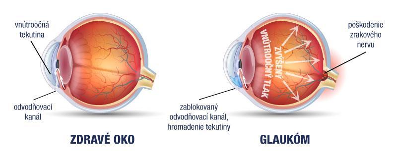 GLAUKOM Autor: Kateřina Marešová Školitel: MUDr