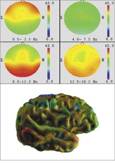 Obrázek 2 Brain mapping ve 2D a 3D obraze.