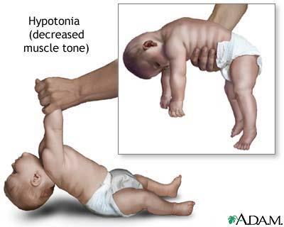Benzodiazepiny Vliv na dítě Vysoká afinita k fetálním proteinům