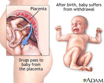 rozštěpových vad Floppy infant Hypotonie Neonatální abstinenční syndrom