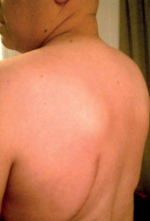 ODBORNÝ ČLÁNEK 13 uložených, menších než 5 cm, ale tato indikace vyžaduje zvážení léčby multidisciplinárním týmem lékařů.