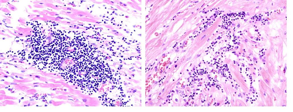 Obrázek 112: Histopatologický obrázek virové myokarditidy po autopsii pacienta s rozvojem městnavého srdečního selhání (autor KGH; https://commons.wikimedia.org/wiki/file:viral_myocarditis_(1).