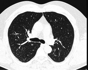 Obr. 5 Silikóza plic prostá na skiagramu hrudníku