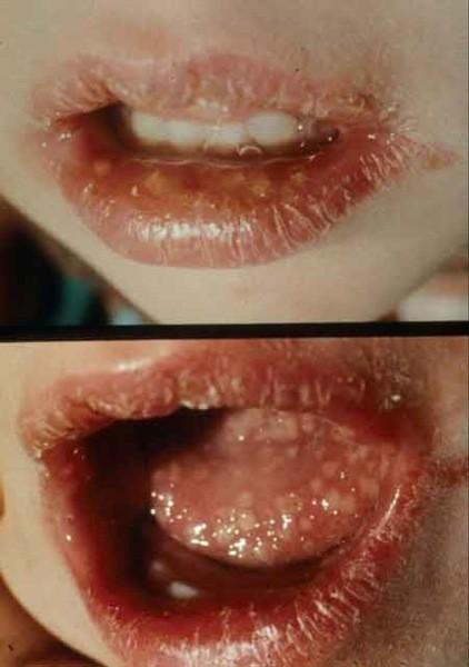 Herpes labialis http://missinglink.ucsf.