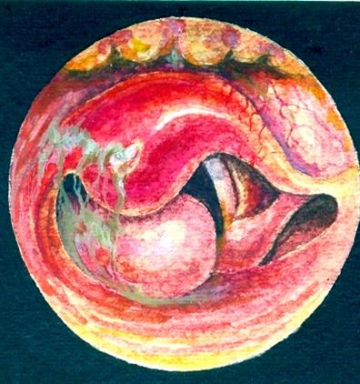 abscedens (oba obr.
