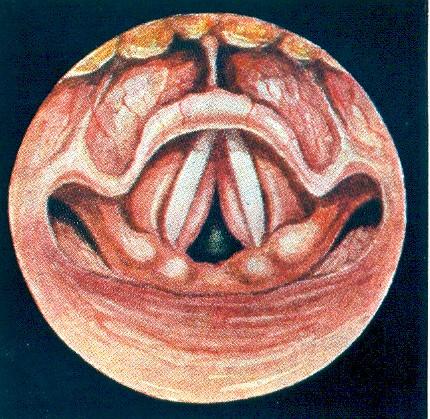 Laryngitis subglottica (J.