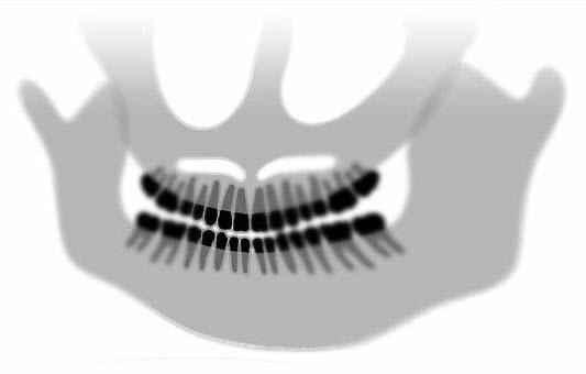 Abyste zajistili správnou polohu pacienta, nastavte jeho polohu tak, aby přední zuby pevně zapadly do drážek na nástavci pro skus.