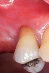 192 ODBORNÉ SDĚLENÍ Obr. 1: Zub 14 určený k extrakci, před výkonem. Obr. 2: Extrahovaný zub 14 s patrným kazem pronikajícím do dřeně, zasahujícím distální plochu korunky a kořene. Obr. 3: Extrakční lůžko po chirurgické extrakci zubu 14 a po rozsáhlé egalizaci kosti.