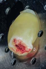 Připojenou gingivu po celém obvodu zubu oddělujeme ostře protětím skalpelem pro vytvoření ostrých chirurgických ran nezbytných k primárnímu hojení, zhmožděný okraj laloku nebo epitel na styku laloků
