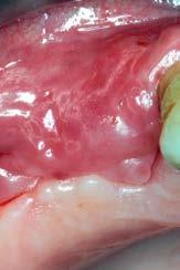 ODBORNÉ SDĚLENÍ 193 Obr. 7 Obr. 8 Obr. 9 Obr. 10 Obr. 7: Hojící se extrakční rána 2 týdny po výkonu. incidenci MRONJ po extrakci zubu, ačkoli prokázaný rozdíl není statisticky významný (25).