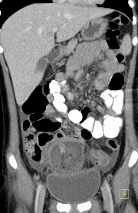 Perforace, absces