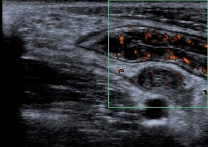 Diferenciální diagnóza Appendicitis Crohnꜥs disease Bowel Wall Thickening absent or mild (ileum) moderate, all layers Echo pattern