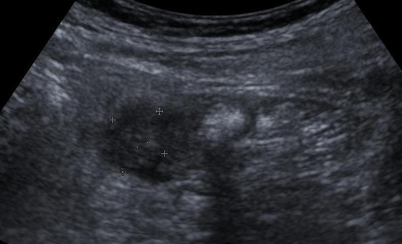 ciprinol + metronidazol