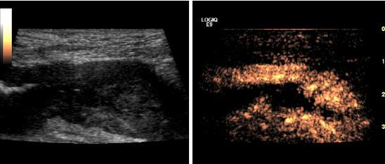 USG rozlišení charakteru stenózy Color/Power Doppler: rozlišení zánět vs.