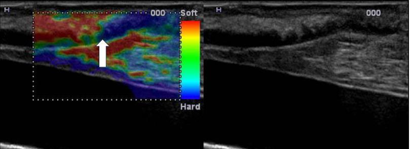 USG elastografie In vitro elastografie stenózy: červená =