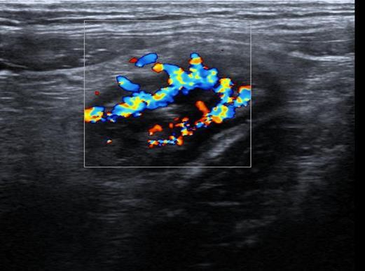 Charakteristické USG nálezy