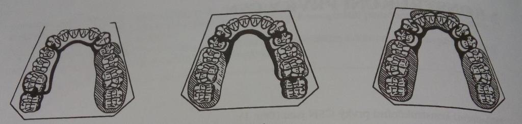 Třídy má tělo tvar desky, přenos je převažně mukózně dentální. Tělo nese nahrazované zuby a doplnuje ztracenou čáast alveoláranícho výběžku čelisti.