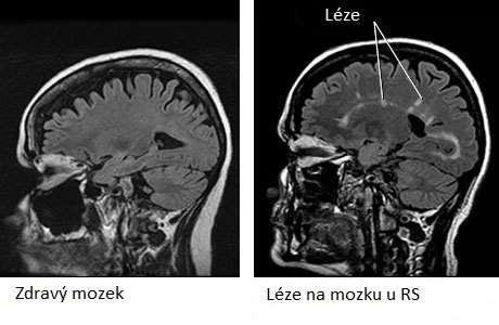 com/multiple-sclerosis/magnetic-resonance-imaging-mri-of-multiplesclerosis, cit 8.3.