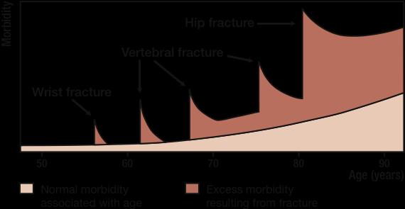 Morbidita Osteoporosa: kaskáda zlomenin X 5 X 2 ÚMRTÍ X 2 Zlomenina obratle Zlomenina kyčle