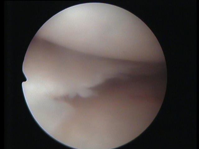 Chrupavky jsou další, často poškozenou strukturou kolenního kloubu.