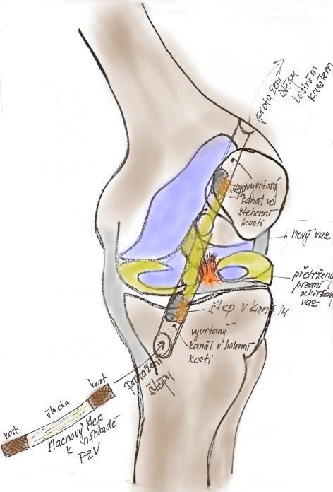 rezonancí, nebo při artroskopickém vyšetření.