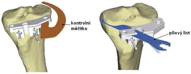 2 Tibiální resekce K tibiální resekci se používají dvě metody cílení. První z nich se nazývá extramedulární cílení a druhá intramedulární cílení.