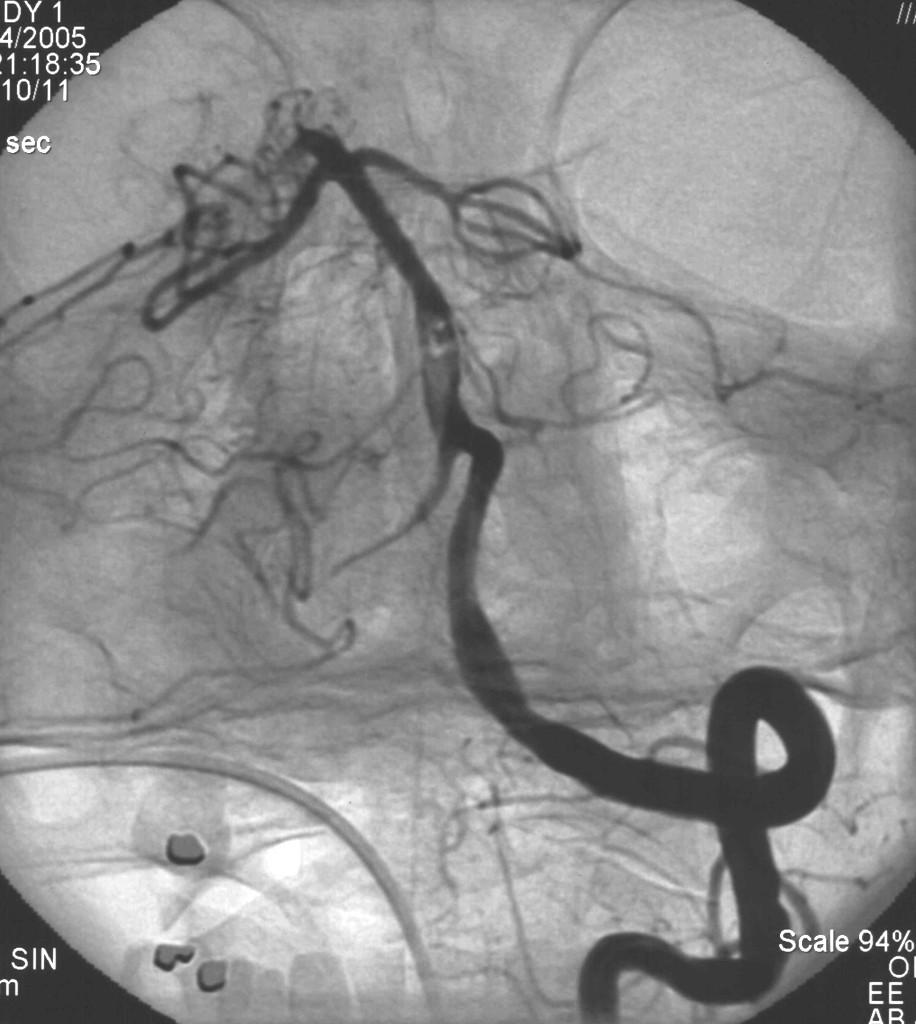 carotid bulb