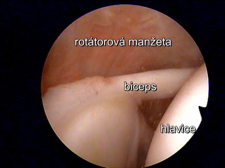 Co se operačně v ramenním kloubu ošetřuje: Rotátorová manžeta Jde o soustavu úponů šlach svalů z okolí lopatky (subscapularis, supraspinatus,