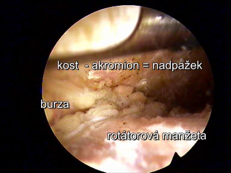 Subakromiální prostor, subakromiální burza Jde o prostor nad rotátorovou manžetou, který bývá vyplněn tíhovým váčkem (burzou), která izoluje šlachy