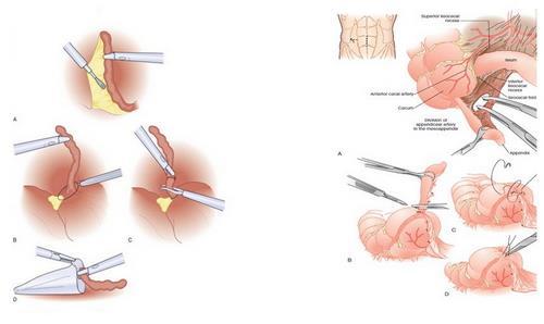 ultrazvuk břicha nebo méně často na CT a RTG. Laboratorně se vyšetřují parametry krevního obrazu, hlavně počet bílých krvinek, dále CRP a jiné známky zánětu.