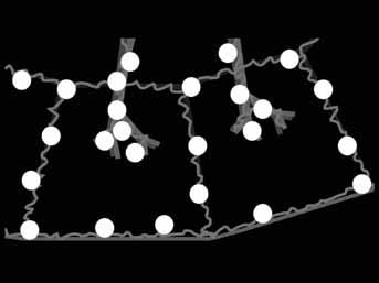 stadia Fig. 5. Perilymphatic nodules in patient with II.