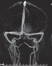 , 11 bulbus VJI, 12 VJI, 13 v. facialis comm., 14 v. retromandibularis, 15 v.