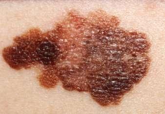 Úvod Malígny melanóm Druh rakoviny kože 160 000 nových prípadov ročne Pacienti prežívajú