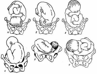 Poloha plodu (situs) vztah podélné osy těla plodu k podélné ose corpus uteri podélná (osy rovnoběžné) - 99%,