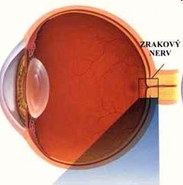 Mezi základní projevy glaukomu patří: změny ve tvaru optického disku