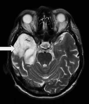 Obr. 1. MR mozku, T2 sekvence významná lokální atrofie pravého temporálního laloku Obr. 2.