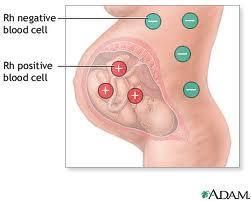 Hemolytická nemoc novorozenců: 85% lidí RhD + RhD - matka imunizace RhD + plodem (porod)