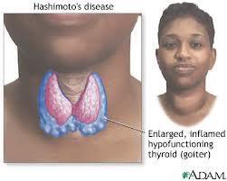 Hashimotova thyroiditida autoprotilátky proti thyroidním