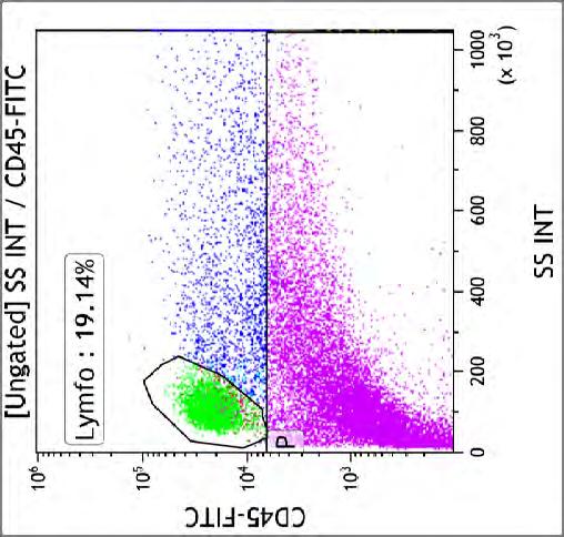 Nádorová infiltrace, (ŠH, 1936 ž) 19 % lymfocytů CD45+ imunofenotypově