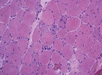 histologie: nekróza svalových vláken a nepřítomnost zánětlivých infiltrátů ve svalové tkáni zvýšená exprese antigenů MHC-I, depozita komplementu C5b9 (MAC) na sarkolemě non-nekrotických vláken v