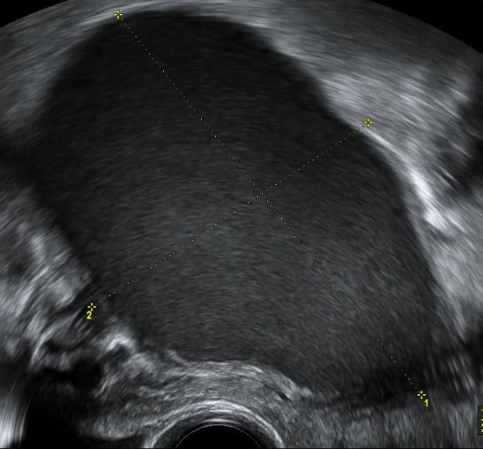 Ovariální endometrióza - endometriom Pseudocysta s čokoládovým obsahem (menstruační krev a její rozpadové