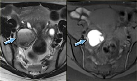 Endometriom T2 T1 STIR CT: cystoidní léze se silnější stěnou, může být septovaná,