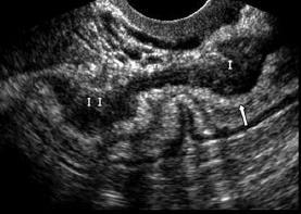 Intestinální endometrióza U 4-15% žen s endometriózou V 72-85% případů rektosigmoideum Příznaky: bolest, obstipace, rektální krvácení Typicky postižení muscularis propria s jejím